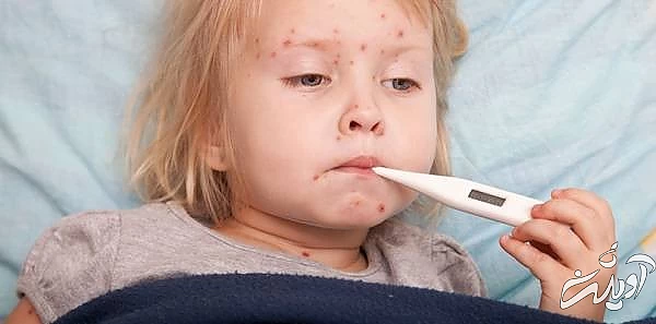 تب در آبله مرغان